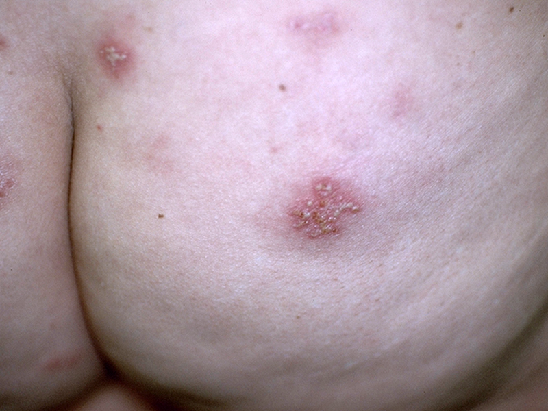 Herpes simplex 1