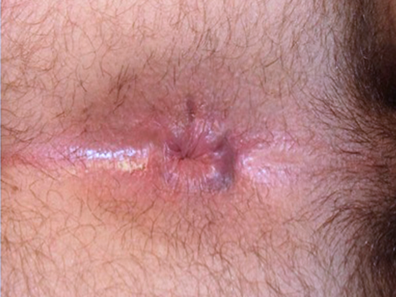 Normal anus Normal anus