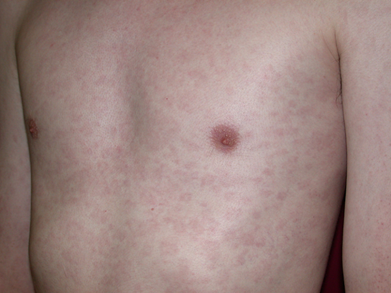 Syphilis rash 1