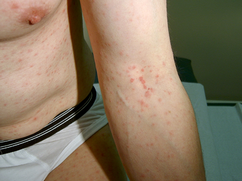 Syphilis rash 2