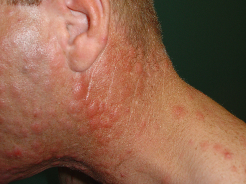 Syphilis rash 6