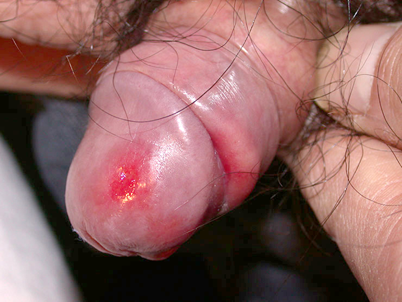 Syphilis ulcer or chancre 2